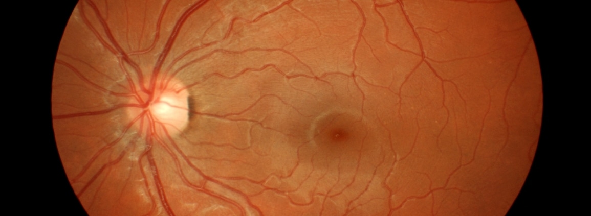 eye_disorders