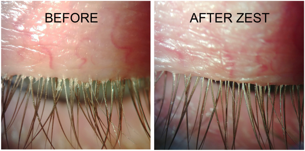 Close-up of reddened skin along the eyelid lash line, showing before and after ZEST treatment (left: before, right: after).